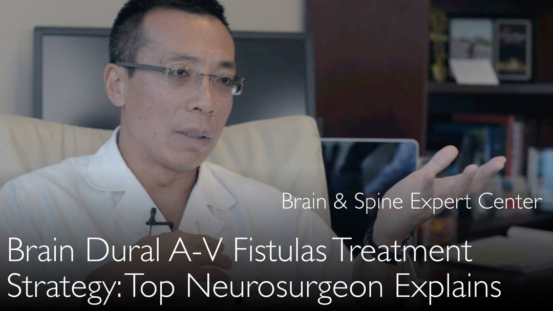 Behandling af dural arteriovenøs fistel i hjernen (DAVF).